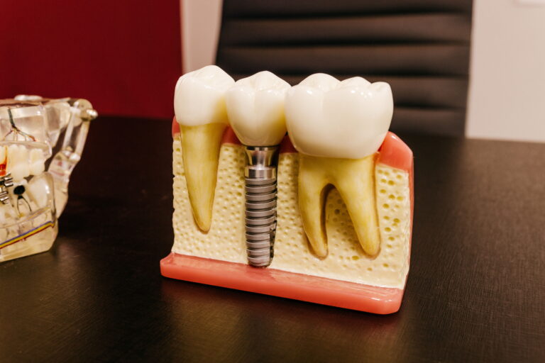 Root Implants with dentist in Ahmedabad